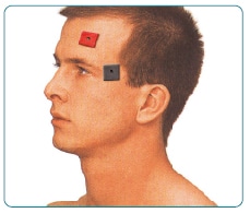 माइग्रेन TENS