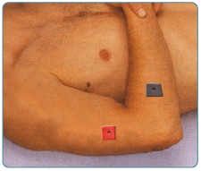 कोहनी दर्द TENS