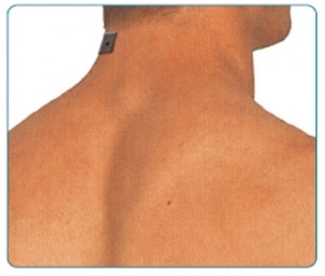 तनाव सिर दर्द TENS