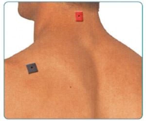 Spannungskopfschmerzen TENS